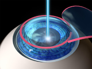Laser-Eye-Surgery